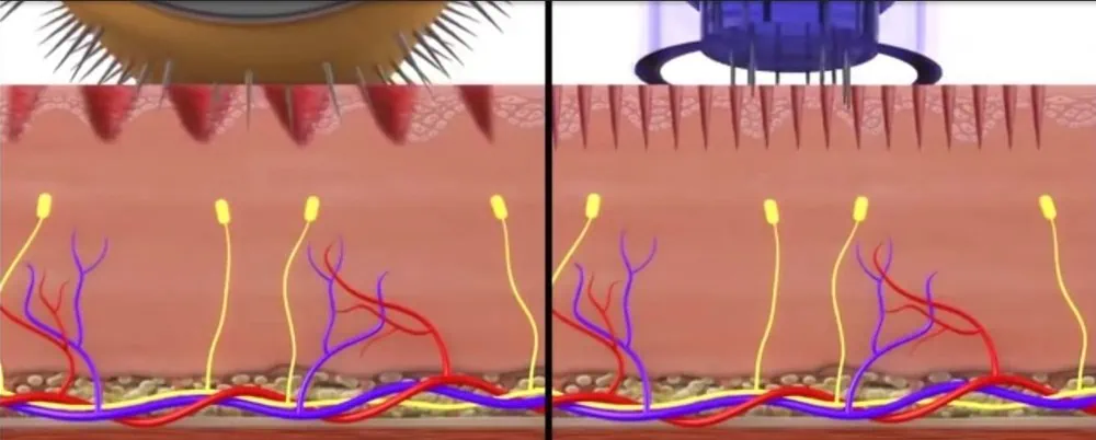 Dermapen og dermaroller lager små mikrokanaler i huden